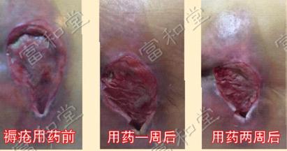【真實案例】褥瘡使用富和堂徐氏燒燙傷保健膏康復(fù)